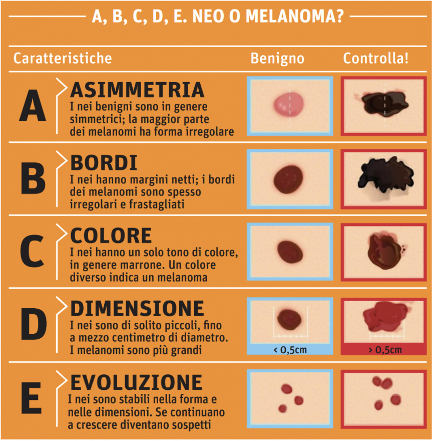 Il principale fattore di rischio per il melanoma è l’esposizione eccessiva e ripetuta ai raggi uv, ma è importante anche monitorare i nei